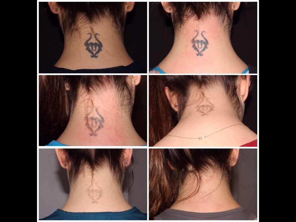 Laser Tattoo Removal in New York City | Central Park Beauty