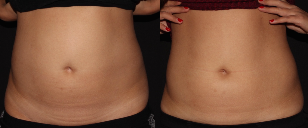 body contouring truSculpt